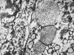 F,64y. | septate junctions between giant multivesicular bodies … uterus, stromal sarcoma F,64y. | septate junctions between giant multivesicular bodies … uterus, stromal sarcoma